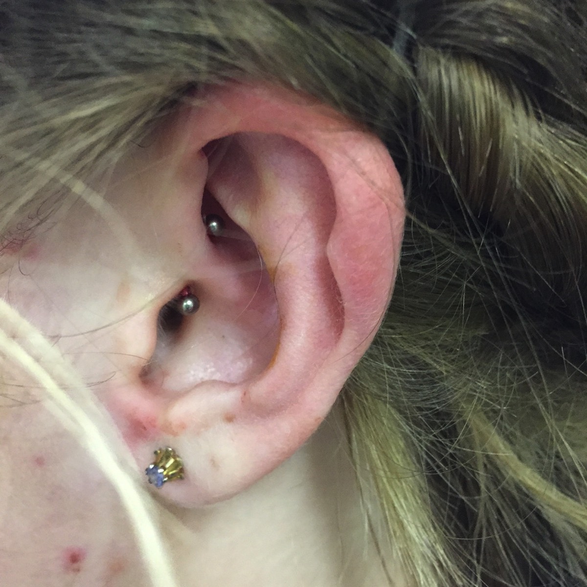 Tragus Piercing for Migraines: Does it Work?